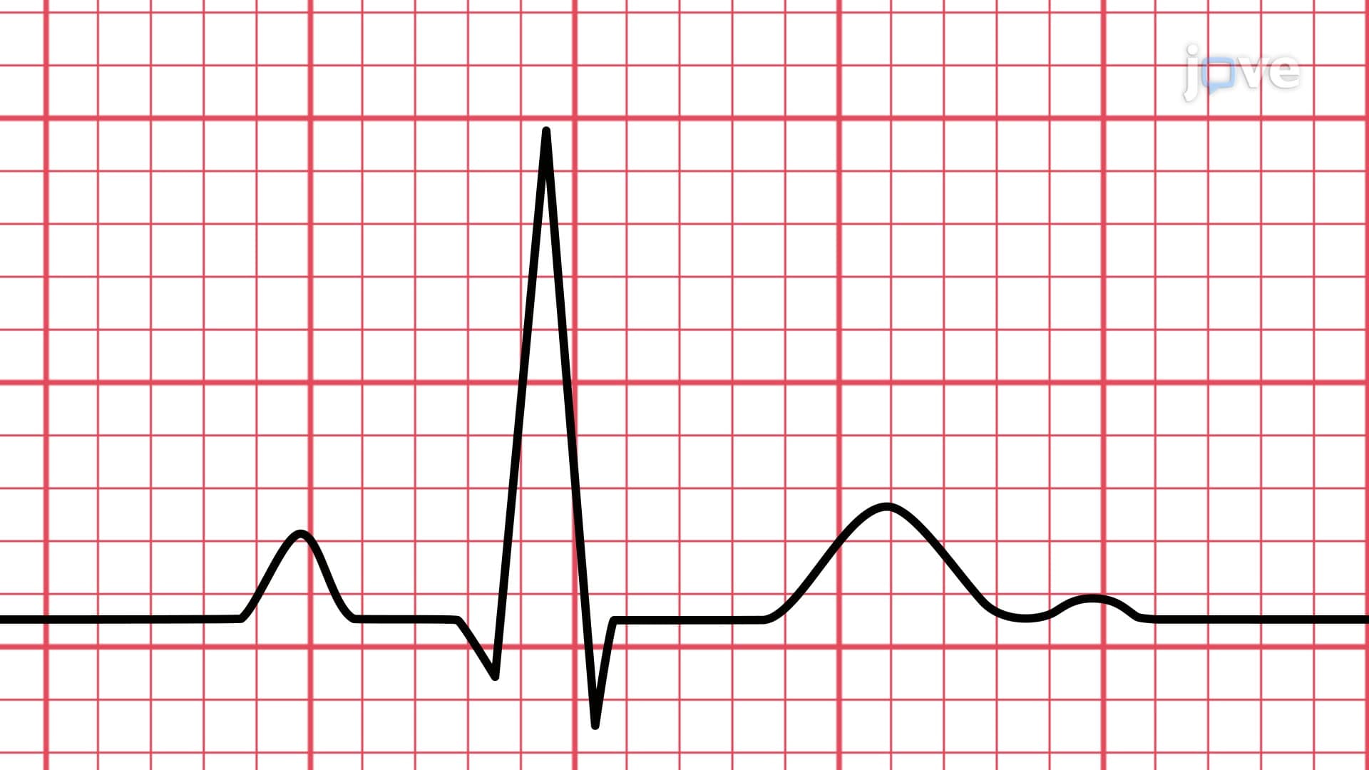 UROP ECG Analysis